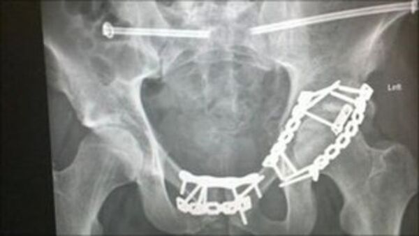 Matthew Lowe: an X-ray image showing bolts, pins, and screws doctors used to repair the horrific damage to his body