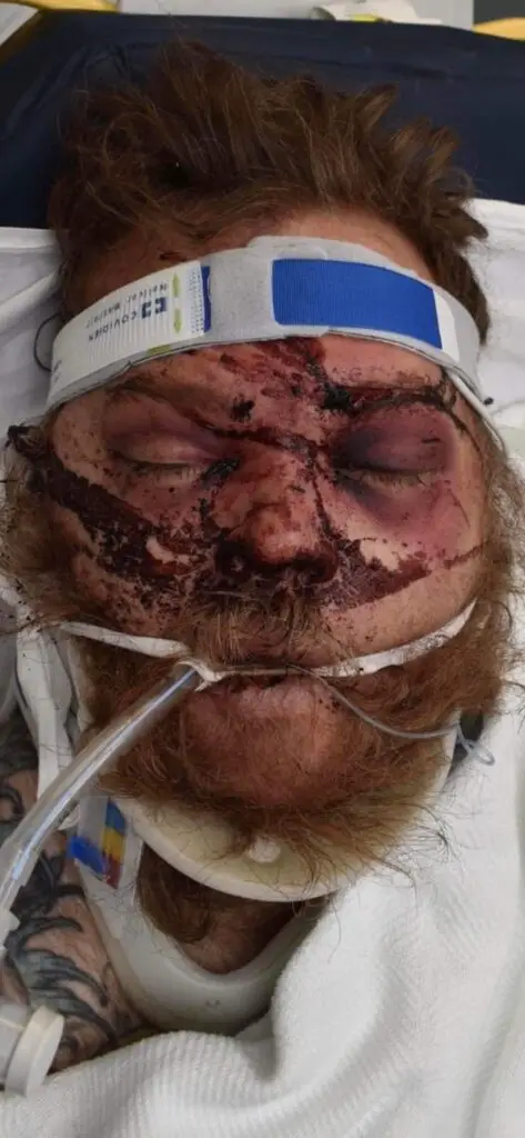 Brandon Embery; photo of blood on face taken at the hospital before death.