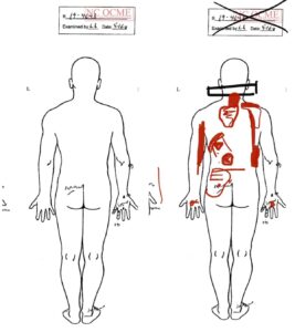 Brandon Embry: autopsy diagram of injuries